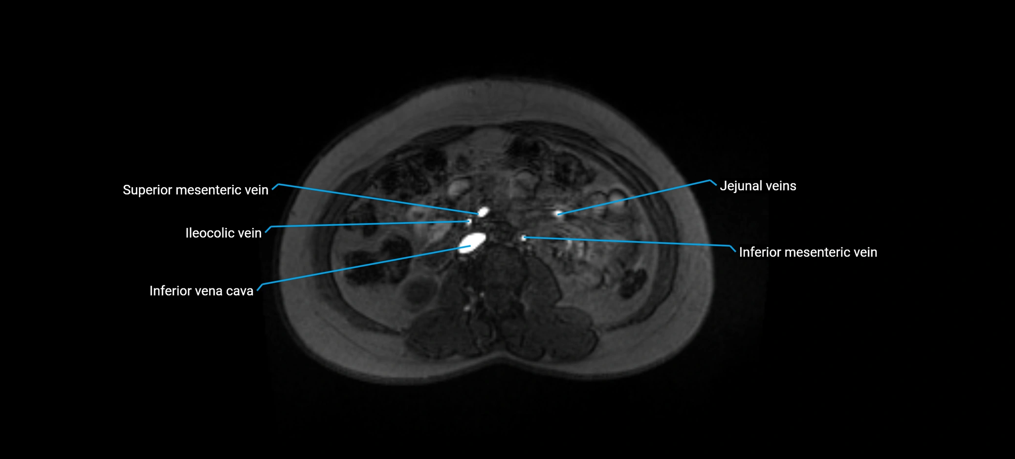 MRV abdomen pelvis & lower limb axial cross sectional anatomy labelled MRI image 86 (1).webp